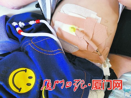 小孩误吞纽扣电池卡在食道口,误吞纽扣电池两幼童食道被腐蚀