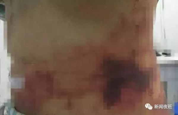 30岁女子腹部吸脂,女子抽脂腿部有黑斑