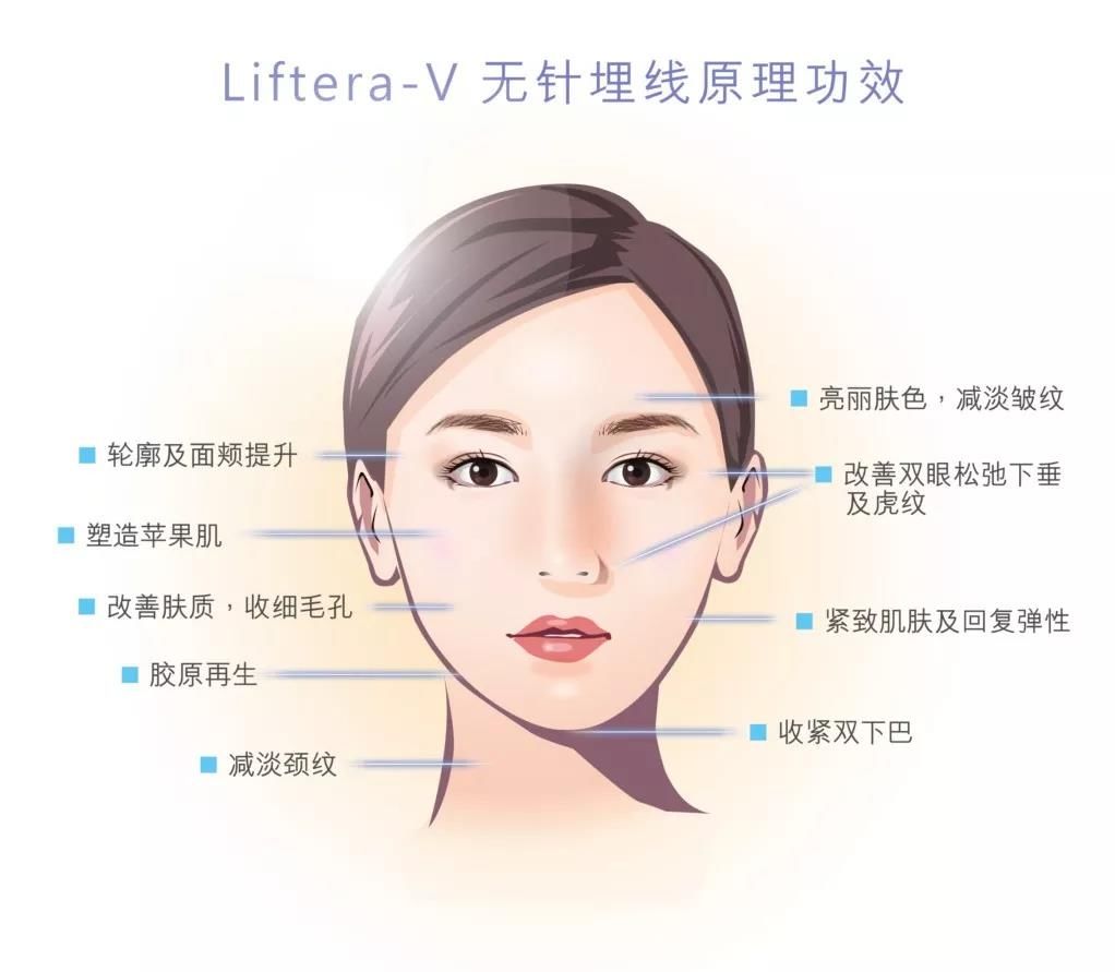 面部提拉无针埋线,无针埋线有护肤效果吗