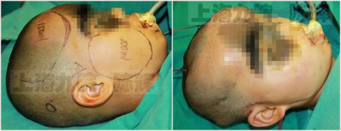 点黑痣后用什么修复最好,黑色素痣扩张术是什么原理