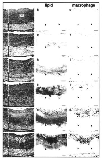 坏胆固醇怎么导致心梗,坏胆固醇偏高原因