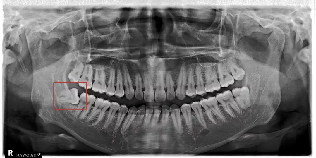 拔智齿注意事项漫画,漫画科普牙科