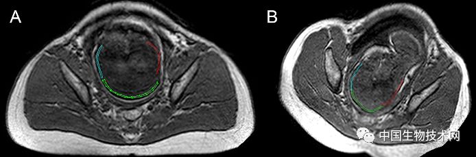 胎儿3d表面成像,3d影像婴儿诞生全过程