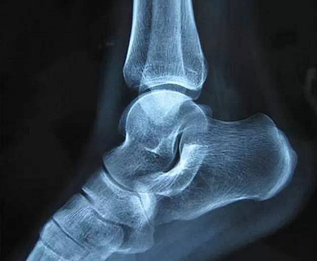 运动扭伤脚踝冷敷还是热敷,扭伤了脚需要冰敷吗还是热敷