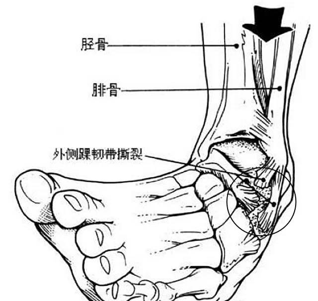 运动扭伤脚踝冷敷还是热敷,扭伤了脚需要冰敷吗还是热敷