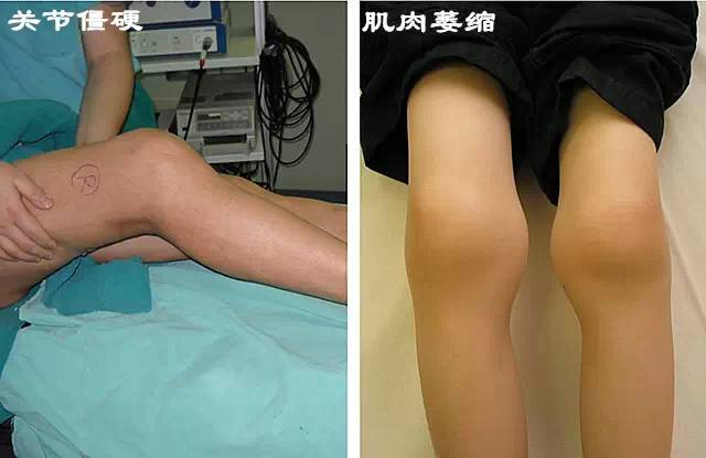 运动扭伤脚踝冷敷还是热敷,扭伤了脚需要冰敷吗还是热敷