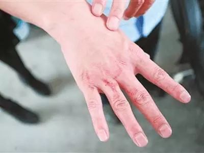 受伤吃酱油皮肤变黑留疤痕怎么办,有伤口不能吃酱油有科学依据吗