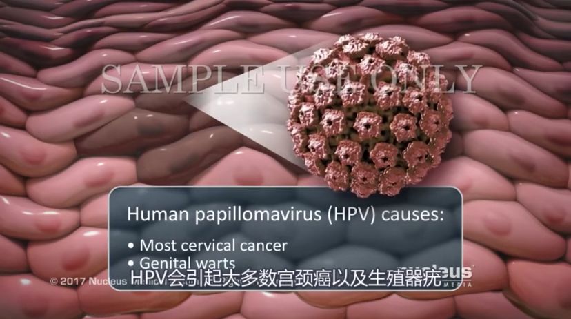 关于hpv宫颈癌您了解多少,如何知道自己得了宫颈hpv