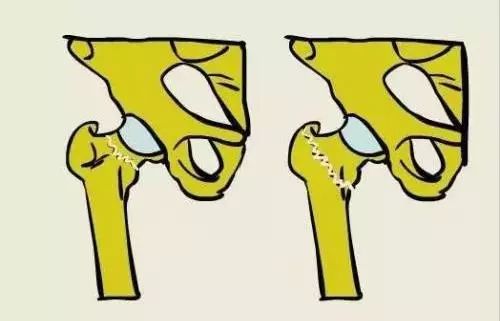 老年人股骨颈骨折康复教程,70岁股骨颈骨折保守治疗成功案例