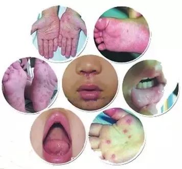 手足口病高发怎么防护看这里,现在是手足口病高发季怎么预防