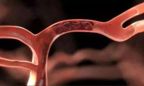 老人熬夜打麻将却造成悲剧,老人打麻将下肢静脉血栓