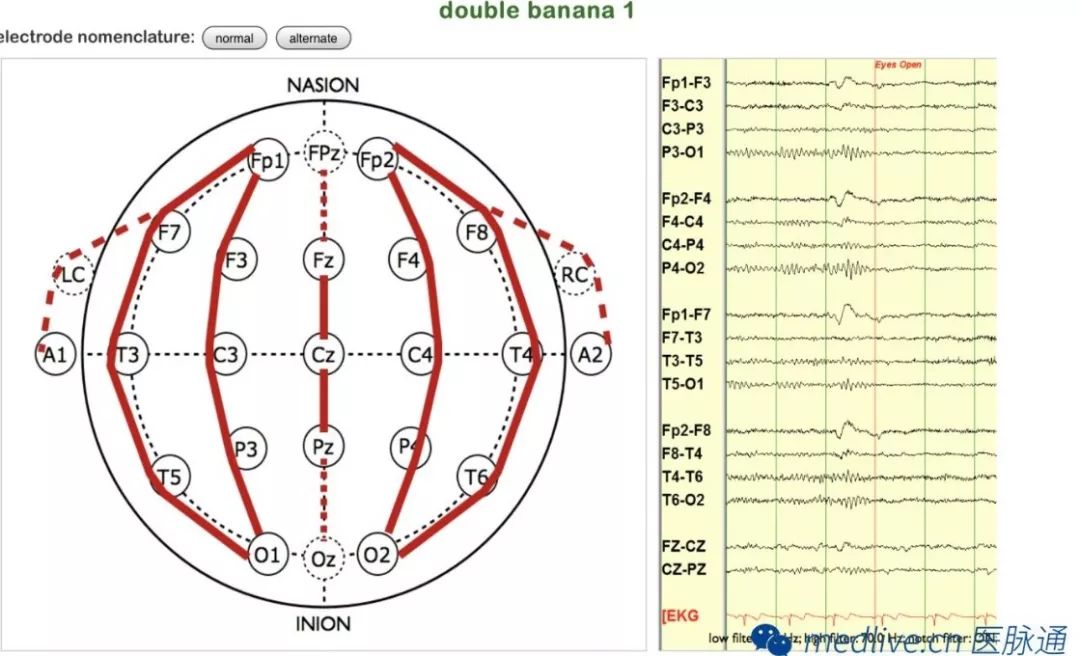 正常脑电图报告单图片,正常脑电图检查报告单第一页