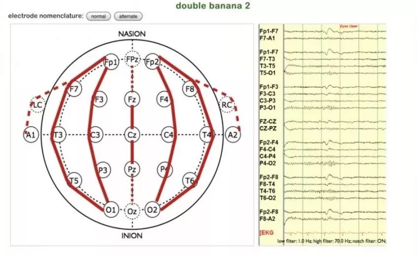 正常脑电图报告单图片,正常脑电图检查报告单第一页