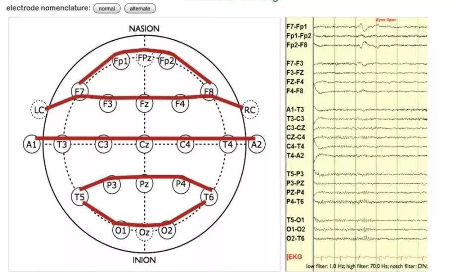 正常脑电图报告单图片,正常脑电图检查报告单第一页