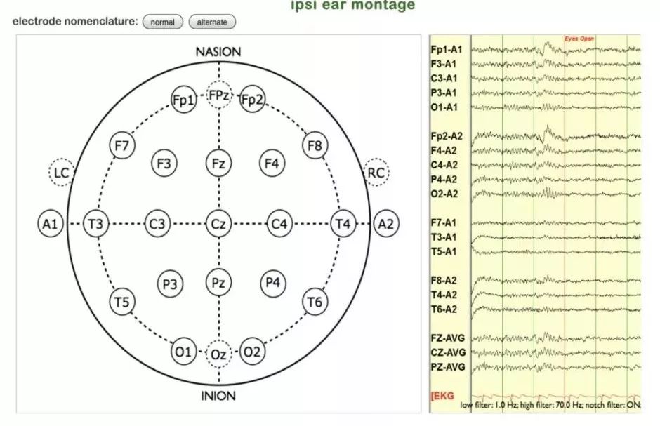 正常脑电图报告单图片,正常脑电图检查报告单第一页