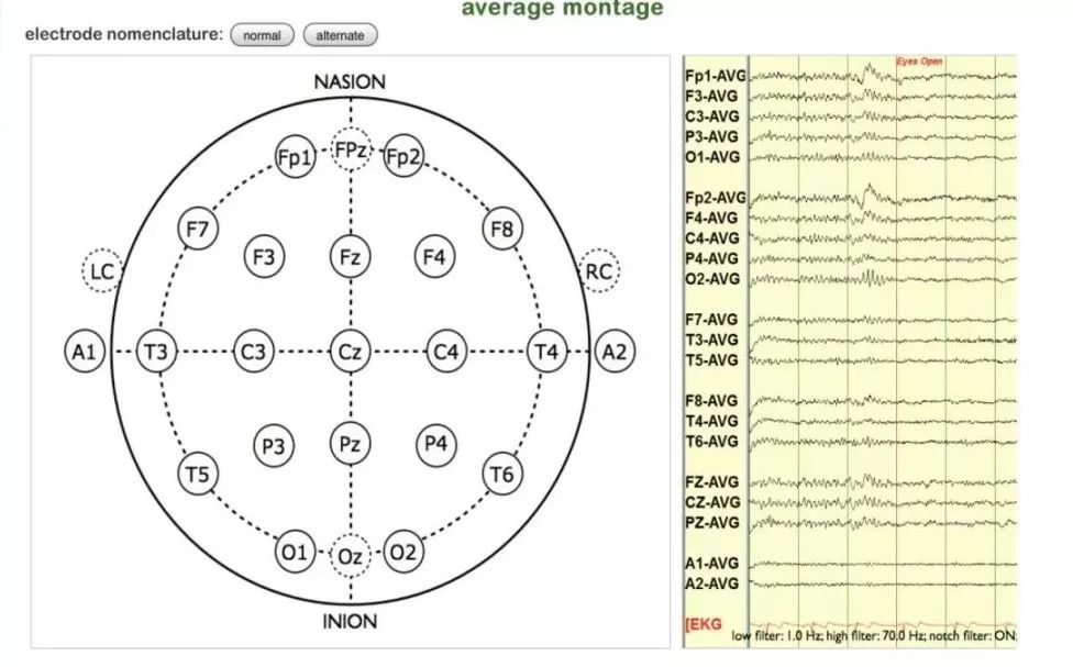 正常脑电图报告单图片,正常脑电图检查报告单第一页