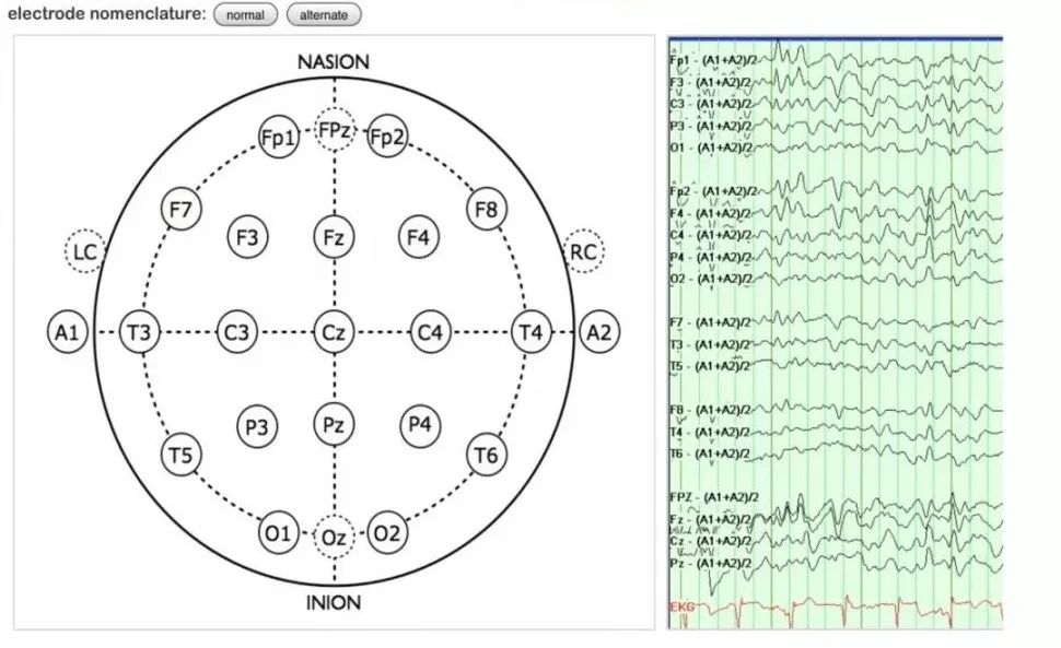 正常脑电图报告单图片,正常脑电图检查报告单第一页