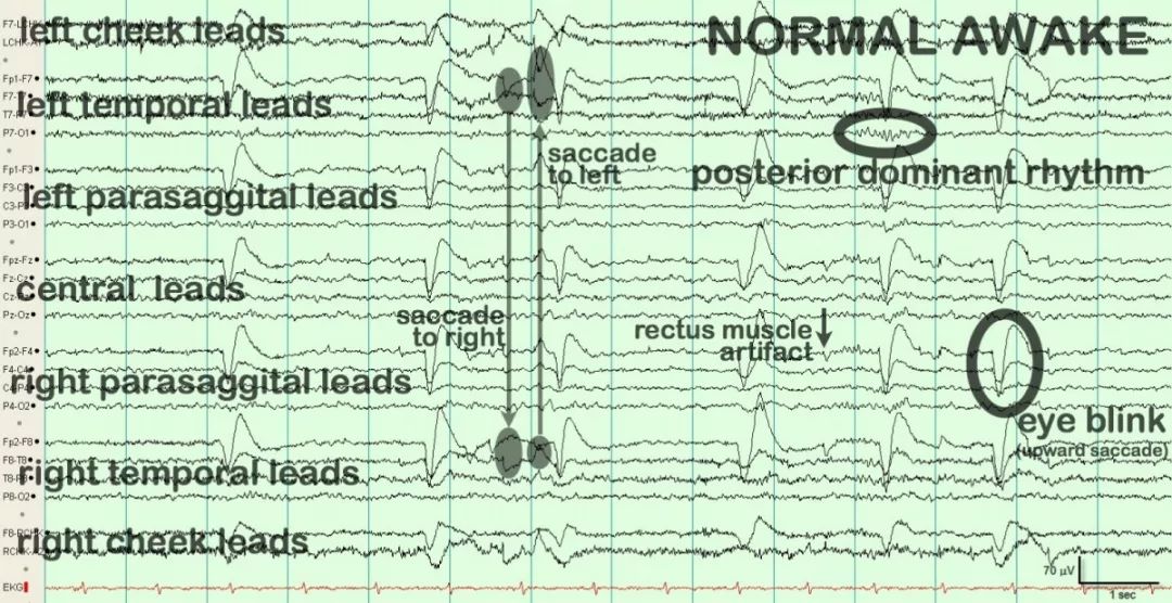 正常脑电图报告单图片,正常脑电图检查报告单第一页