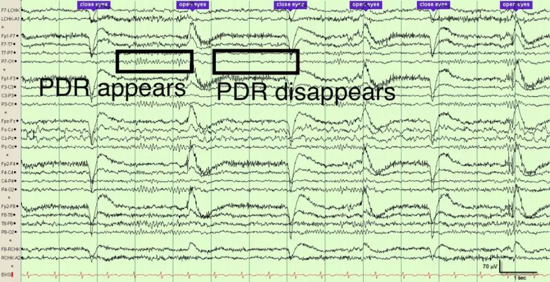 正常脑电图报告单图片,正常脑电图检查报告单第一页