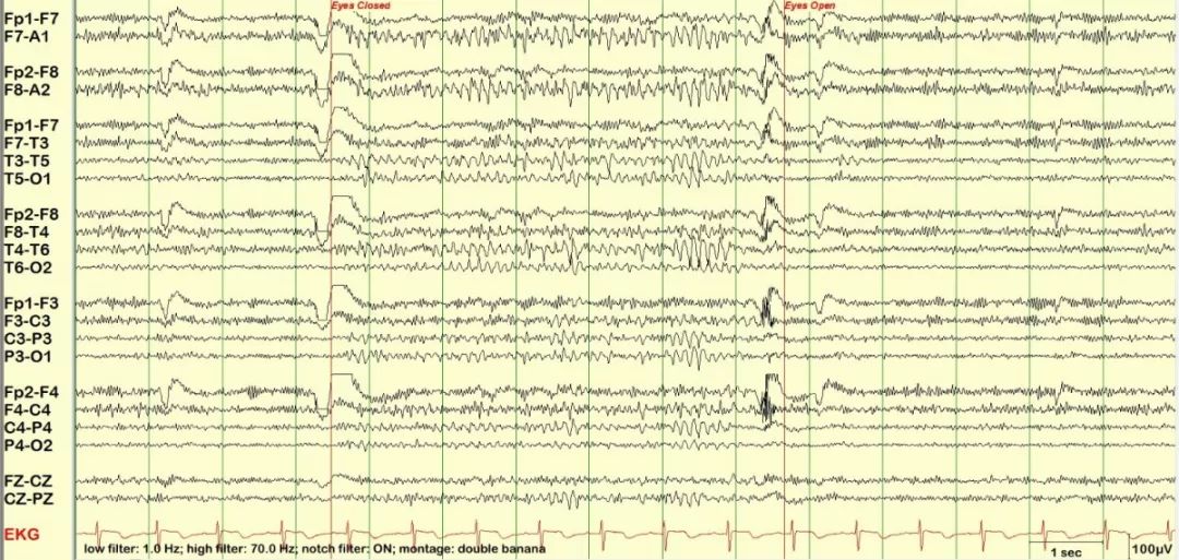 正常脑电图报告单图片,正常脑电图检查报告单第一页