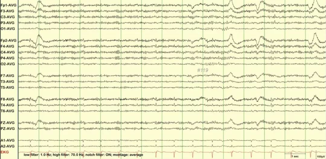 正常脑电图报告单图片,正常脑电图检查报告单第一页