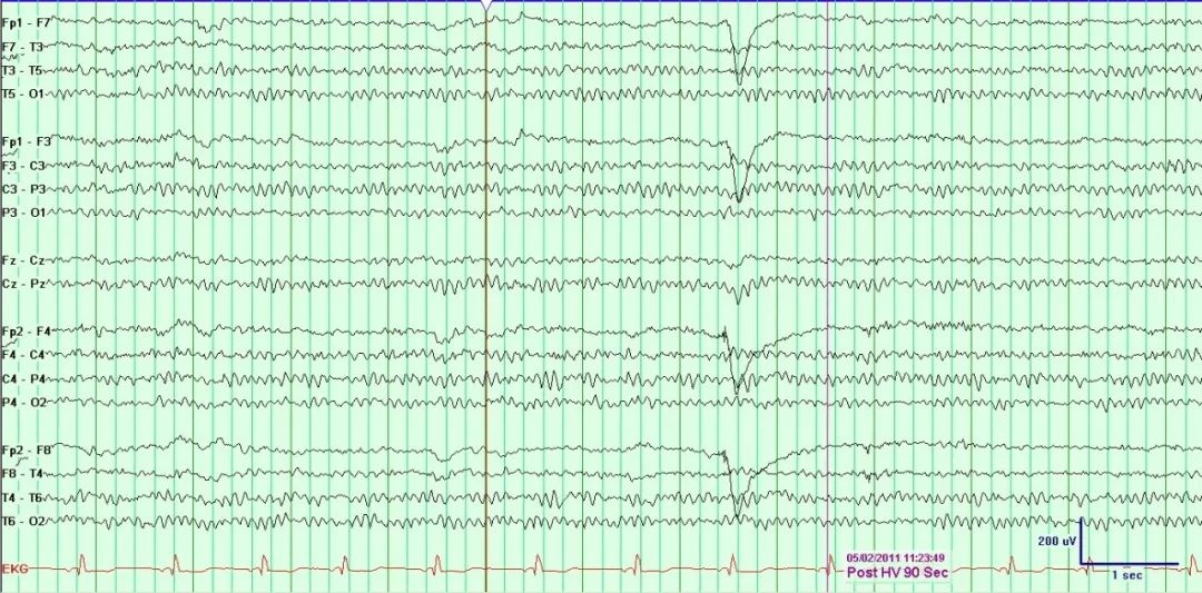 正常脑电图报告单图片,正常脑电图检查报告单第一页