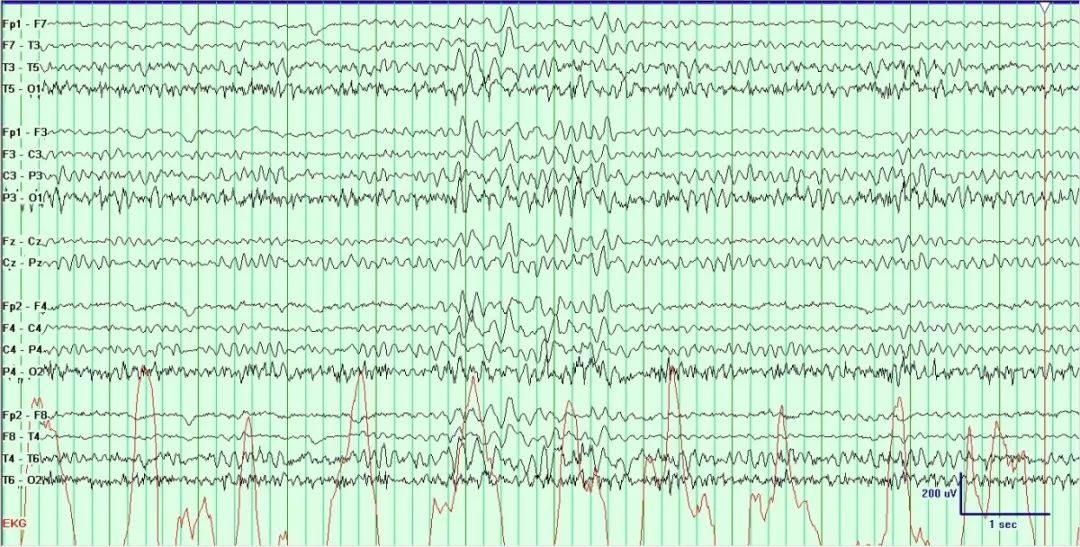 正常脑电图报告单图片,正常脑电图检查报告单第一页