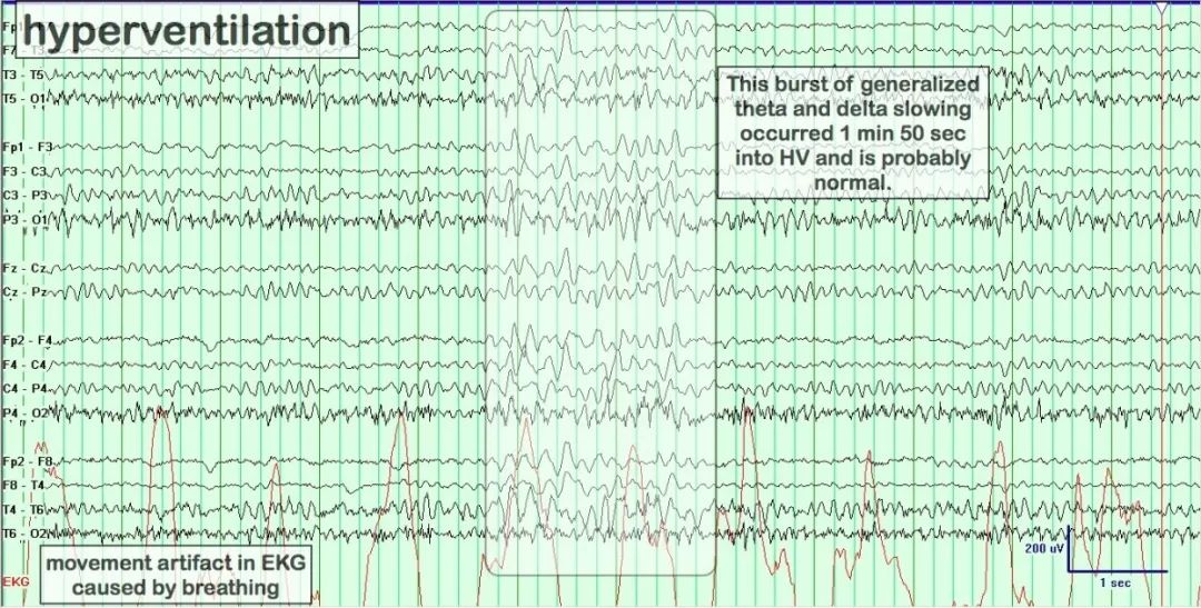 正常脑电图报告单图片,正常脑电图检查报告单第一页