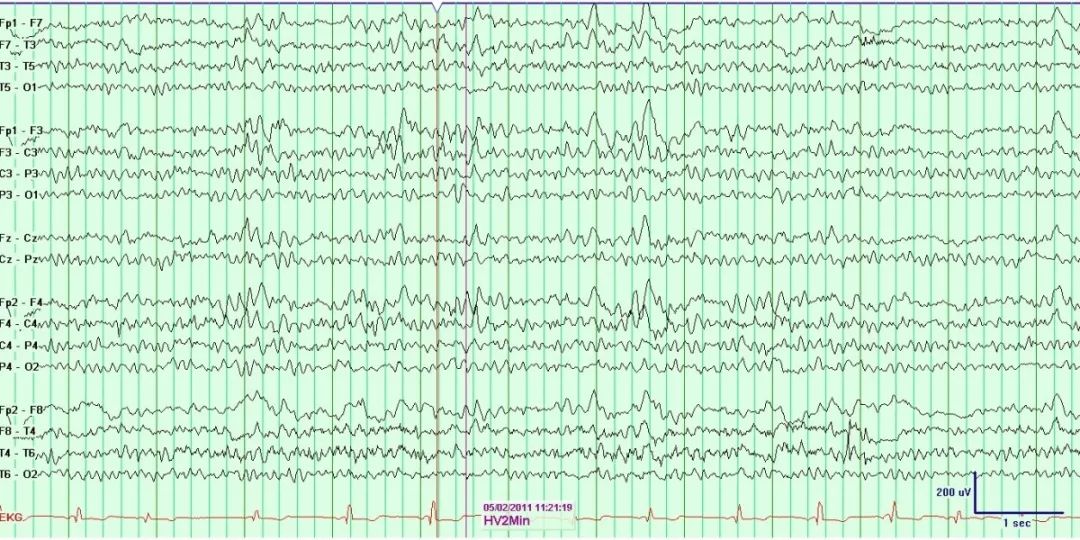 正常脑电图报告单图片,正常脑电图检查报告单第一页