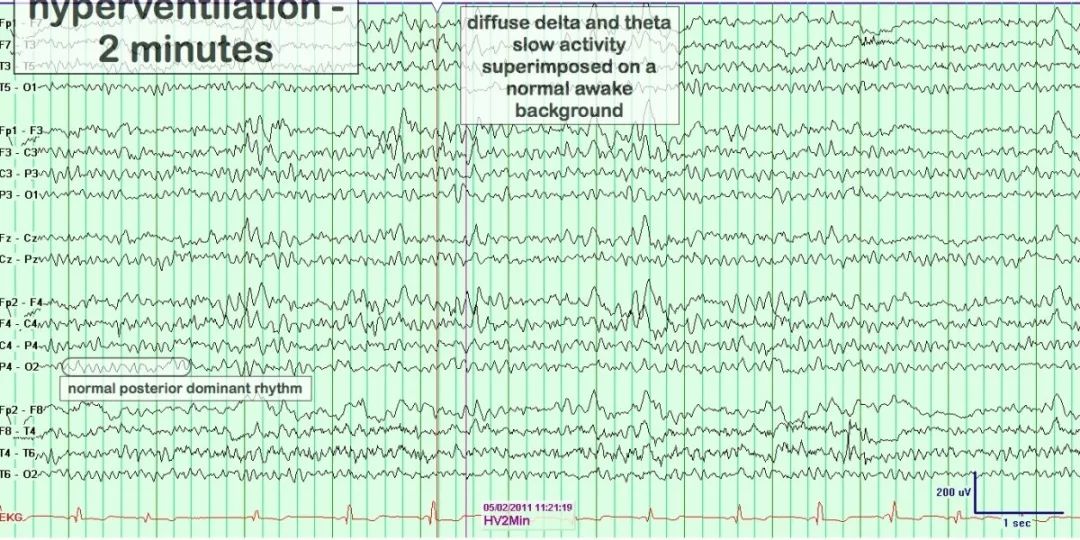 正常脑电图报告单图片,正常脑电图检查报告单第一页
