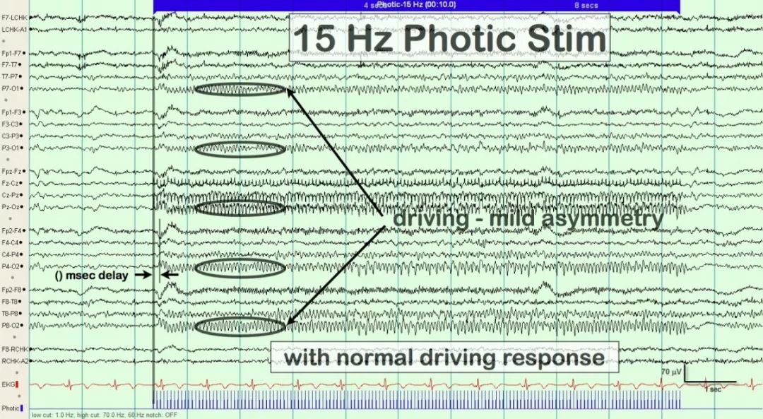 正常脑电图报告单图片,正常脑电图检查报告单第一页