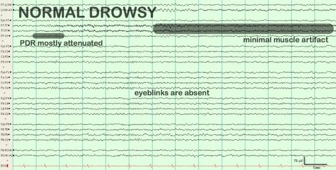 正常脑电图报告单图片,正常脑电图检查报告单第一页