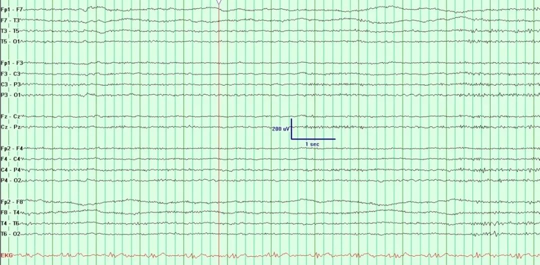 正常脑电图报告单图片,正常脑电图检查报告单第一页
