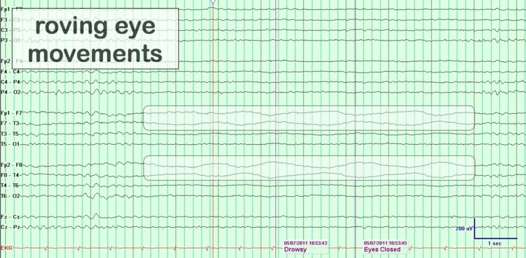 正常脑电图报告单图片,正常脑电图检查报告单第一页