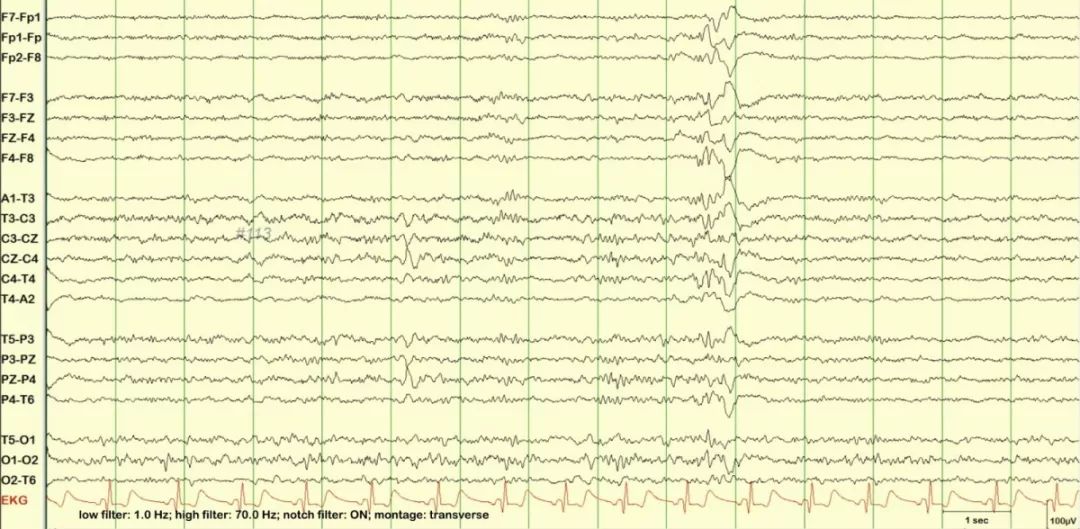 正常脑电图报告单图片,正常脑电图检查报告单第一页