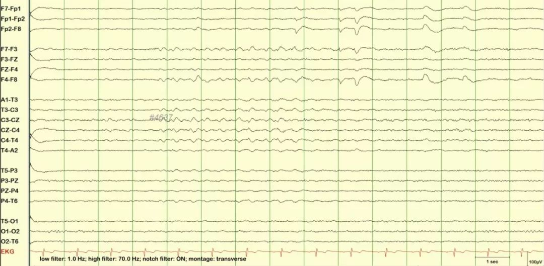 正常脑电图报告单图片,正常脑电图检查报告单第一页