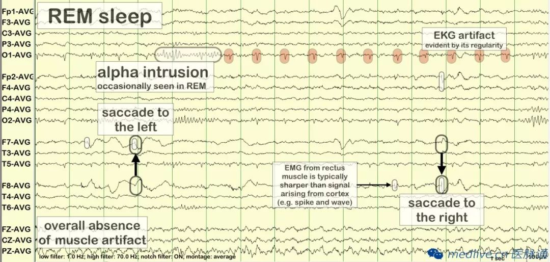 正常脑电图报告单图片,正常脑电图检查报告单第一页
