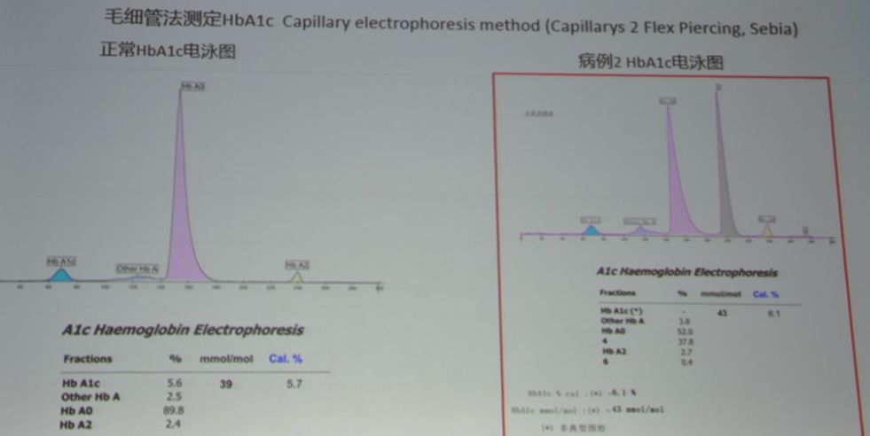 周翔海教授：糖化血红蛋白测量值不准确可能与这些因素有关|PUDF2019