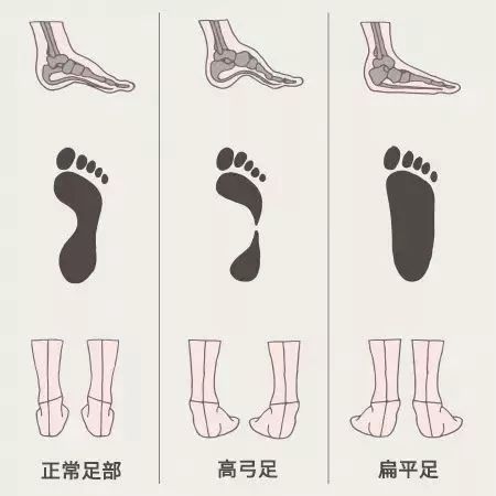 图解鞋底磨损4大类型,一个月鞋底就磨损是不是质量问题