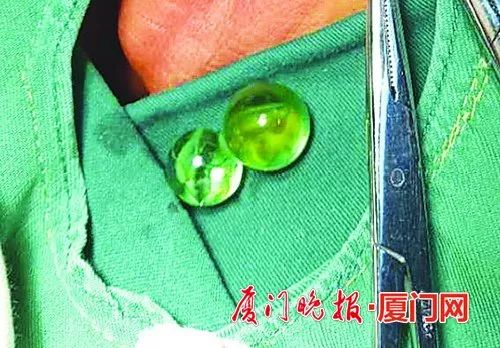 厦门5岁男孩把两颗玻璃珠塞进*体下**，还和姐姐一起瞒着父母！结果