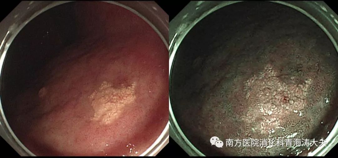 胃黄色瘤可能是除菌后早期胃癌的预测标志物之一