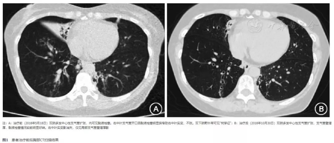 注射用奥马珠单抗治疗过敏性鼻炎,奥马珠单抗治肺曲霉菌