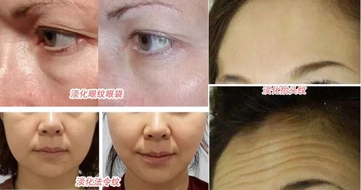 抬头纹法令纹鱼尾纹克星能管用吗,抬头纹鱼尾纹法令纹均可改善