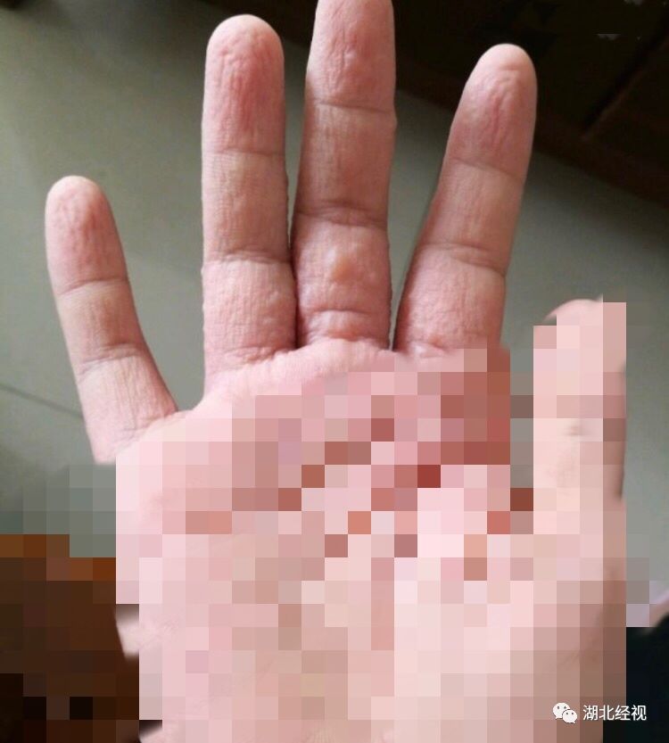 手上起小水泡很痒还脱皮传染吗,五月份手上起小水泡很痒怎么办