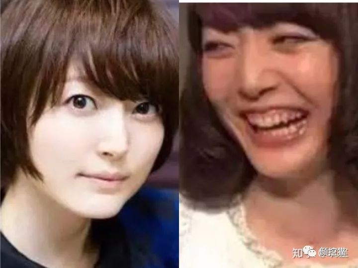 一笑就露出牙花怎么办,口呼吸导致的露龈笑如何治疗