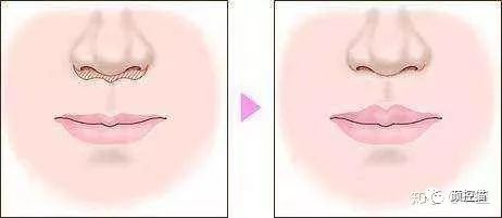 一笑就露出牙花怎么办,口呼吸导致的露龈笑如何治疗