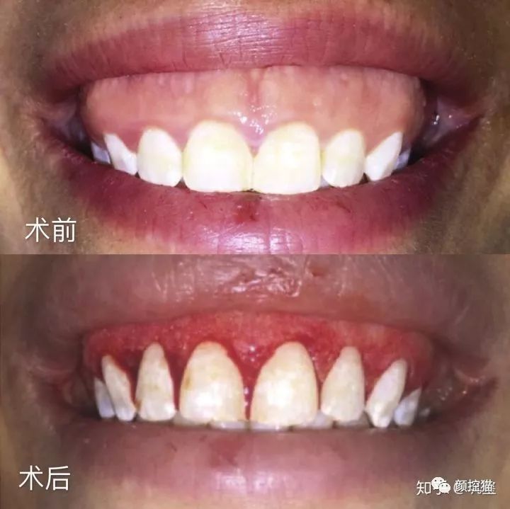 一笑就露出牙花怎么办,口呼吸导致的露龈笑如何治疗