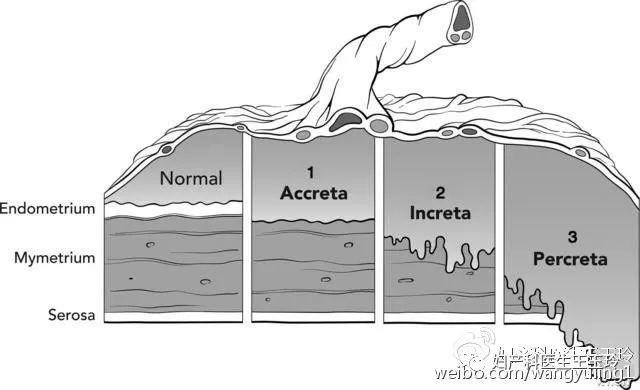 产后胎盘残留不出血怎么办,剖腹产胎盘是如何娩出的