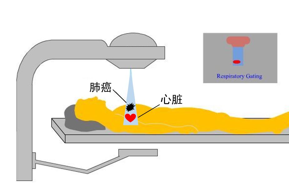 全球最新治疗癌症的进展,质子重离子治愈率最高的六种癌症