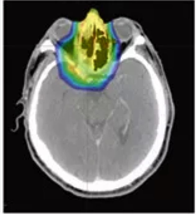全球最新治疗癌症的进展,质子重离子治愈率最高的六种癌症